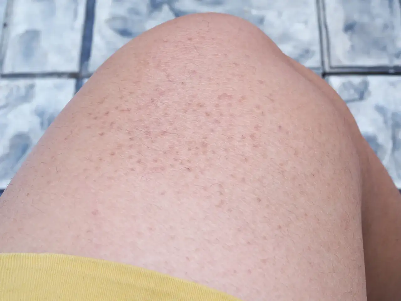 Piel con queratosis pilaris, peque&ntilde;as protuberancias rojas y &aacute;speras. Algunas personas notan que su queratosis pilaris empeora al consumir gluten.