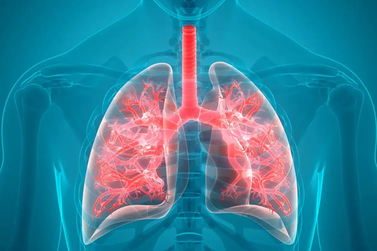 Pulmones rojos y ramificados dentro de un contorno azul del torso. Parece que hay mocos en el pecho, obstruyendo las vías respiratorias.