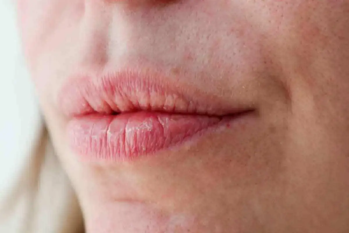 Labios blancos y agrietados, con piel seca y escamas.