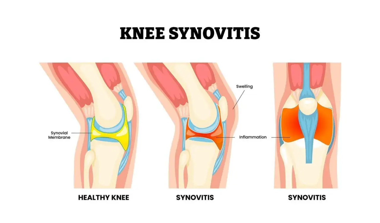 Ilustración compara rodilla sana con sinovitis, mostrando inflamación y hinchazón que pueden causar crujido rodilla.