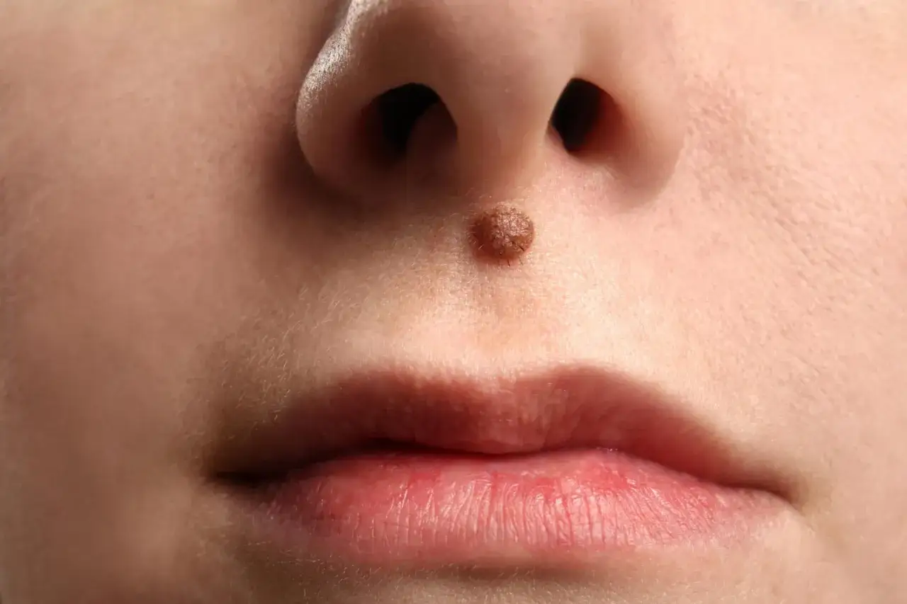 Un lunar en la cara, justo encima del labio superior, cerca de la nariz.