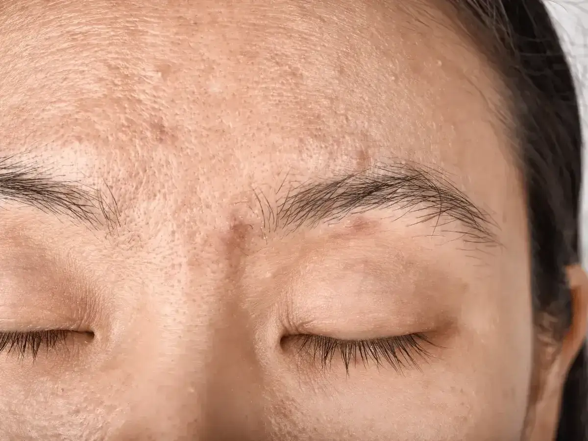 Primer plano de la frente y ojos cerrados de una persona, mostrando manchas en la cara por el sol y poros dilatados.
