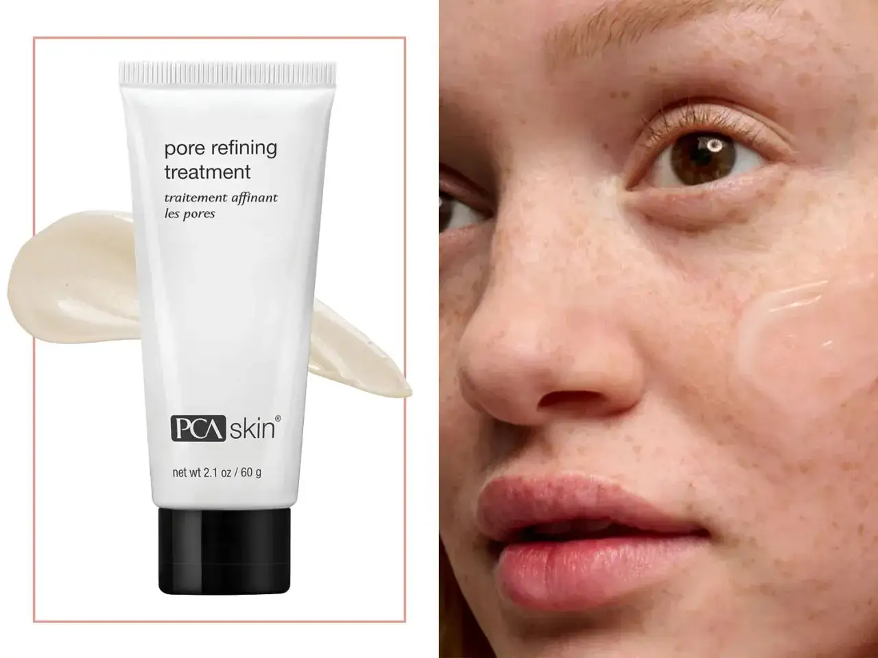 Crema PCA Skin para refinar poros dilatados, aplicada en piel con pecas.