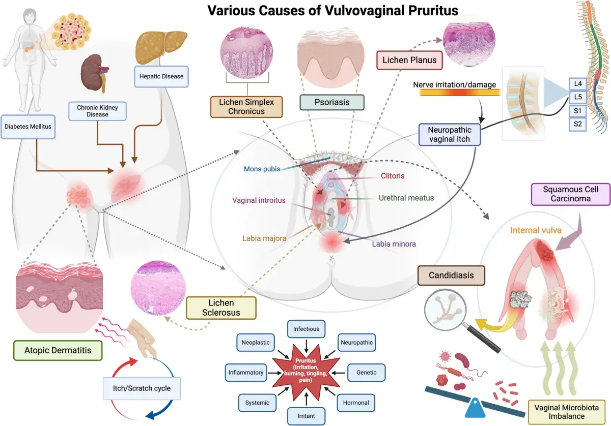 Diagrama de causas del prurito vulvovaginal, incluyendo diabetes, enfermedad hep&aacute;tica, psoriasis, candidiasis y desequilibrio de la microbiota, que pueden causar picor &iacute;ntimo.