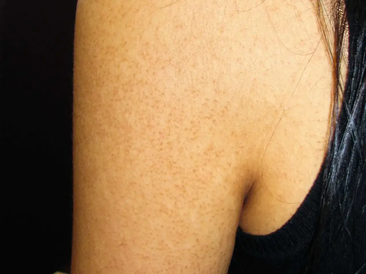 Primer plano de un brazo con piel de gallina, mostrando pequeños puntos y vellos finos.