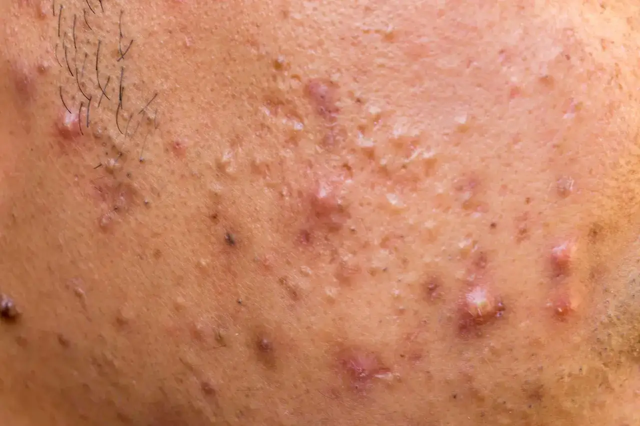 Primer plano de piel con acné, puntos negros y vello facial. Se observa un grano ciego inflamado.