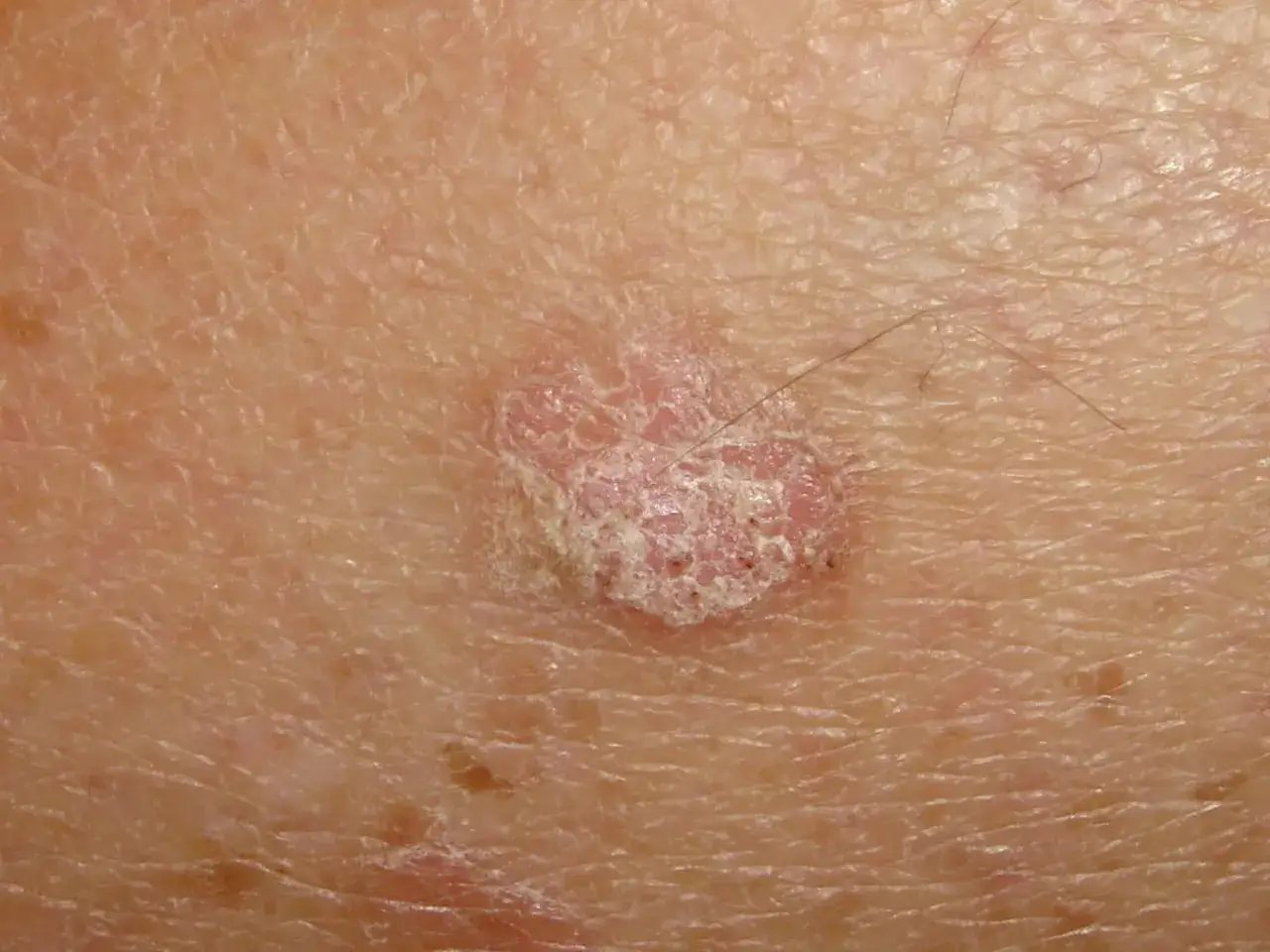 Lesión cutánea rosada y escamosa, característica de una queratosis actínica, con finos vellos sobre la piel.