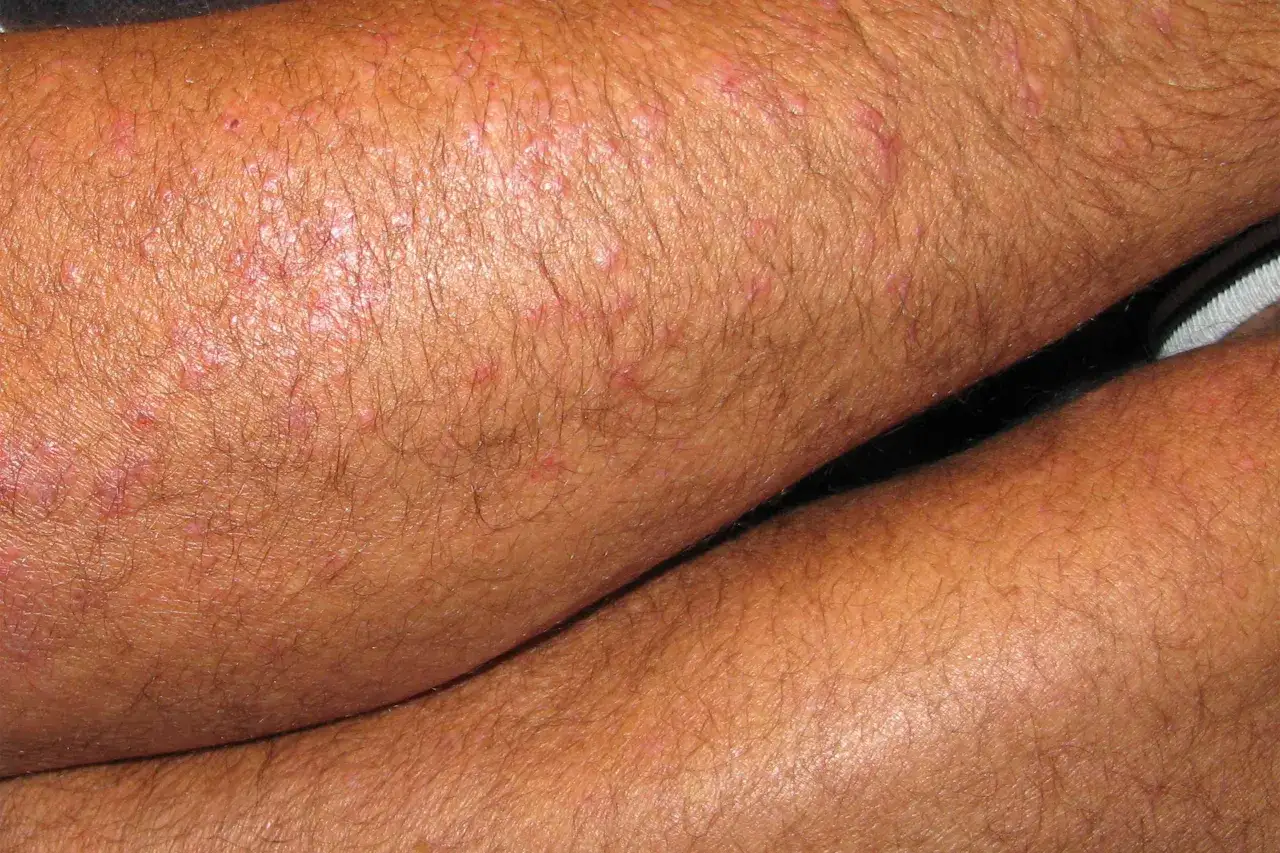 Piel con erupción rojiza y pequeños bultos, posible zonne allergie.