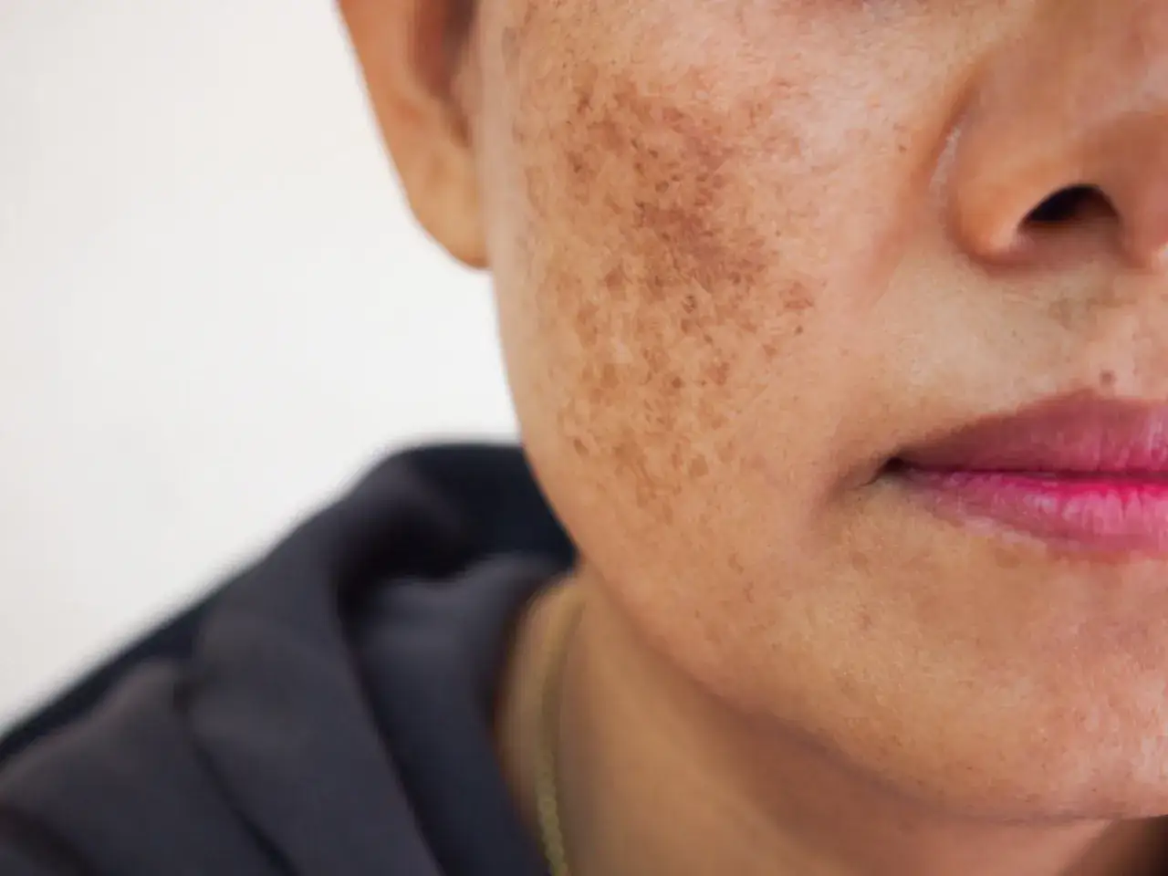 Primer plano de una mejilla con melasma facial, mostrando manchas oscuras y piel.