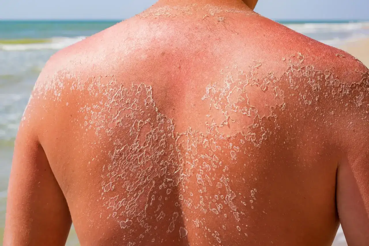 Espalda enrojecida por el sol, con la piel pel&aacute;ndose en parches blancos. Un recordatorio de la importancia de la protecci&oacute;n solar.