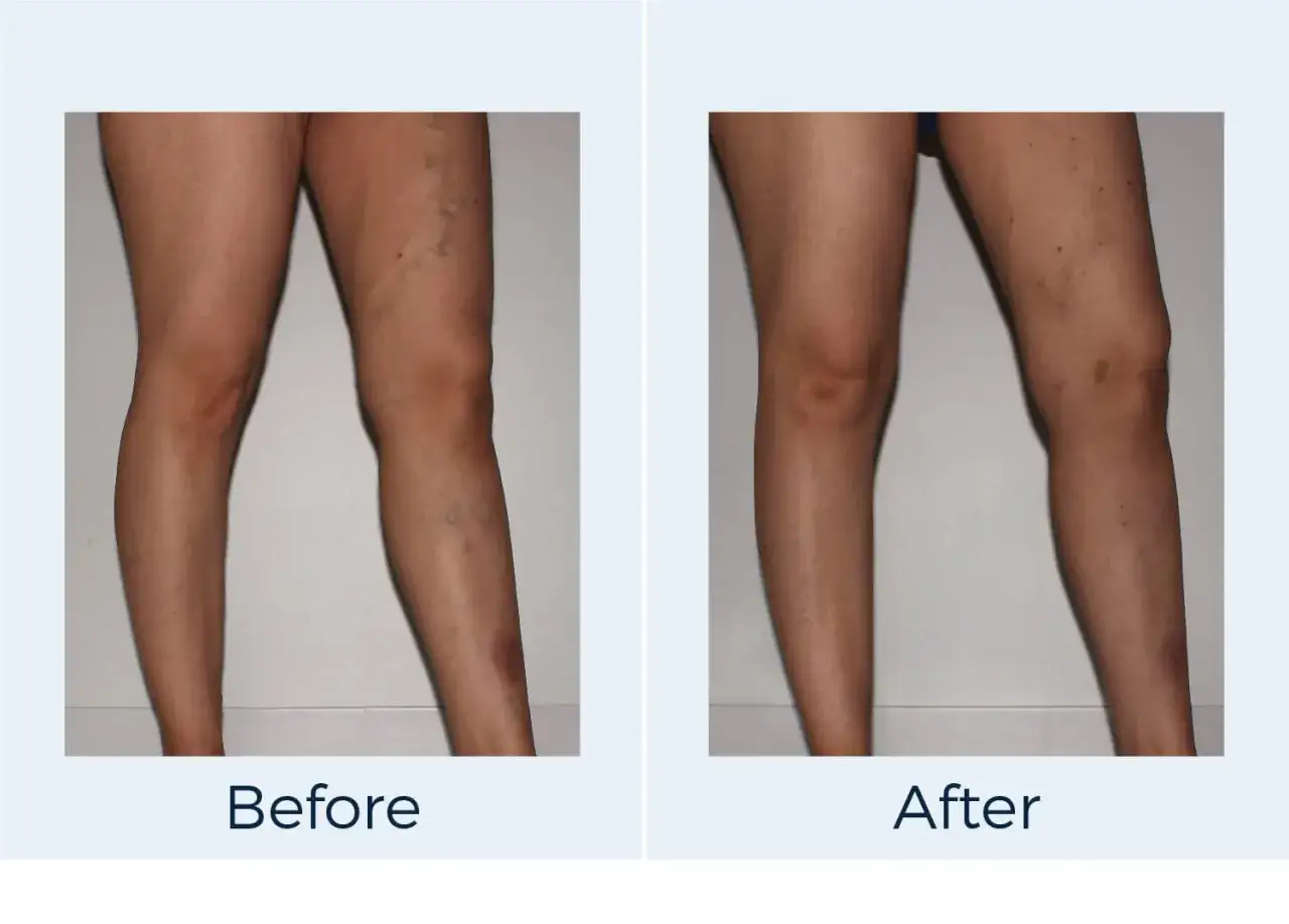 Piernas con arañas vasculares antes y después del tratamiento.