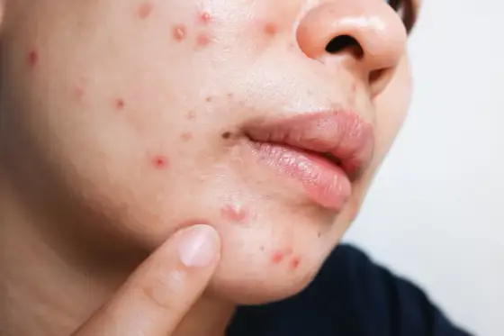 Queratosis Pilaris y Gluten - ¿Hay conexión real?