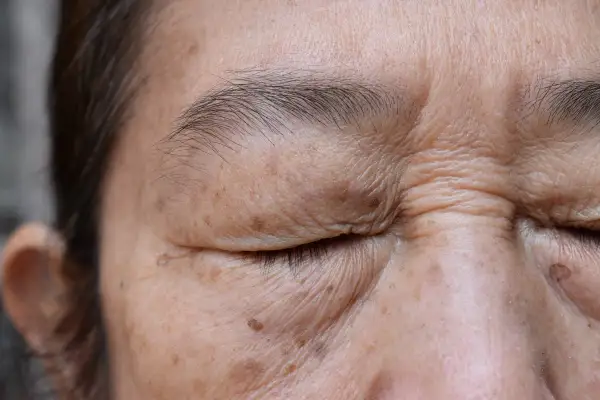 Piel con arrugas y manchas marrones, indicativo de lentigo solar benigno.