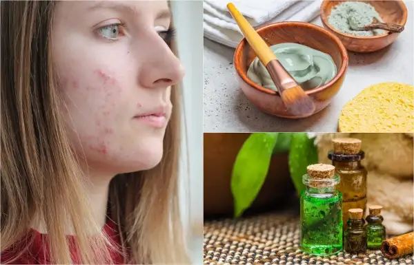 Rostro con acné y tratamientos naturales: mascarilla de arcilla, aceites esenciales y esponja. Adiós a cada grano ciego.