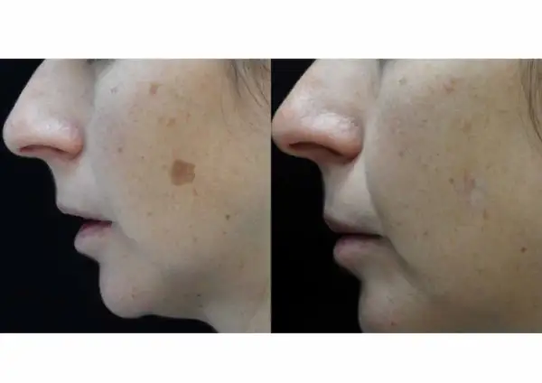 Comparación de rostro con manchas solares antes y después de aplicar remedios caseros para manchas en la cara por el sol.