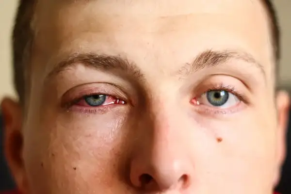 Ojo rojo e irritado, buscando remedios caseros para la conjuntivitis.
