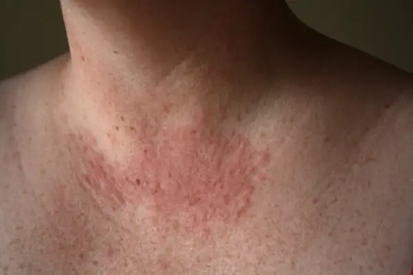 Piel enrojecida y con bultos en el cuello y pecho, posible reacción a la zonne allergie.