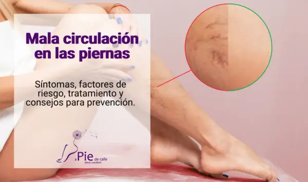 Piernas con mala circulación, mostrando arañas vasculares. Texto: "Mala circulación en las piernas. Síntomas, factores de riesgo, tratamiento y consejos para prevención.