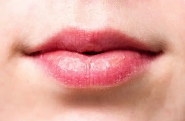 Labios agrietados y secos, con aspecto de labios quemados por el sol, mostrando la necesidad de protección e hidratación.