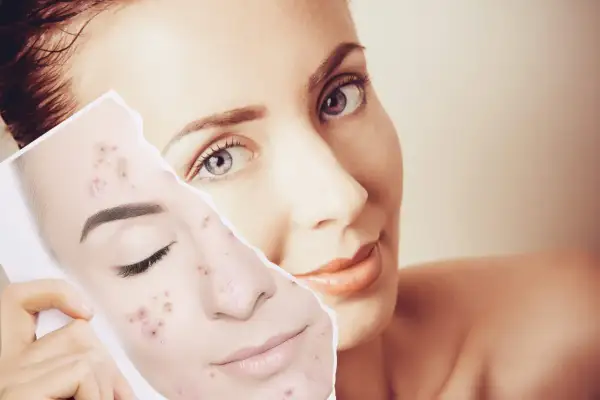 Una mujer muestra una foto de su rostro con acné, preguntándose cuánto tarda en regenerarse la piel.
